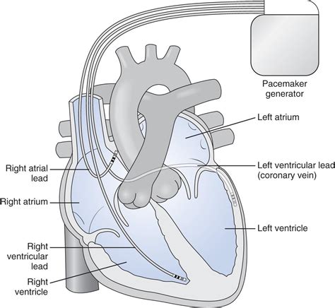 Cardiac pacing for bradycardia, conduction abnormalities, and heart ...