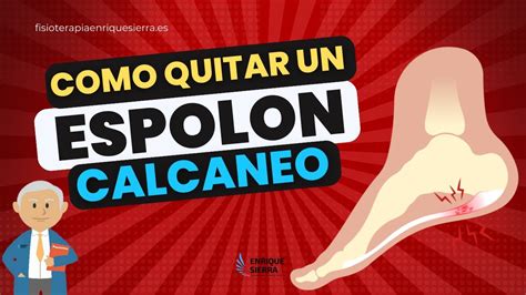 CÓMO QUITAR UN ESPOLÓN CALCÁNEO ONDAS DE CHOQUE - YouTube