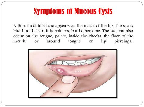 PPT - Mucous cysts (Mucoceles): Symptoms, causes, treatment and preventions. PowerPoint ...