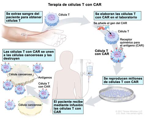 Medula Ossea Leucemia Linfoblastica Aguda