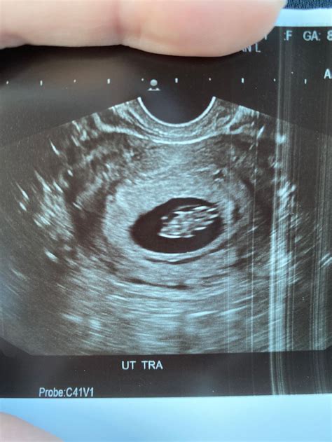 8 Week Ultrasound