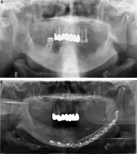 Comparison of Osteoradionecrosis of the Jaw After Superselective Intra-arterial ...