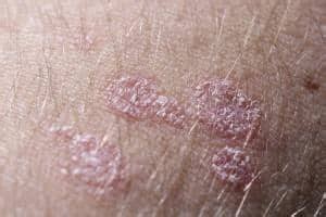Seborrheic Dermatitis – types, causes, treatment, complications and ...