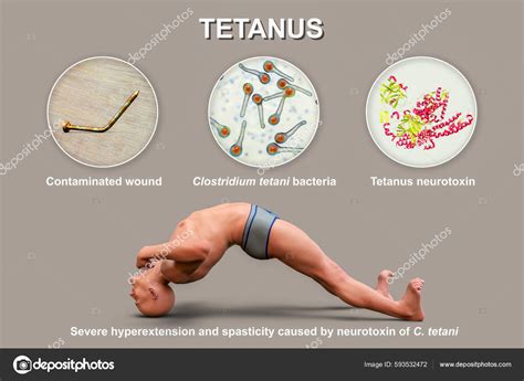 How Fast Can Tetanus Kill You