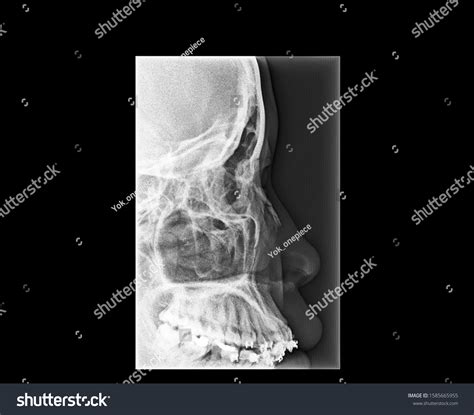 Xray Of Broken Nose Royalty Free Stock Photo Image Clavicle Stock ...
