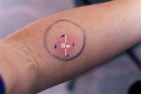 That’s quite a TB test you have there… – karenmagid