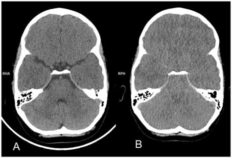 Fatal Fulminant Epstein–Barr Virus (EBV) Encephalitis in ...