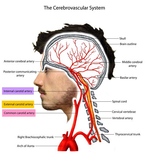 Carotid artery disease - Stenosis, Carotid Artery Dissection