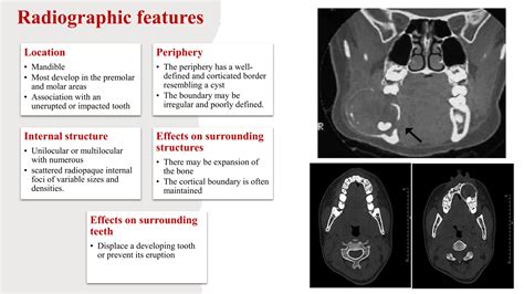 Adenomatoid odontogenic tumor, calcifying epithelial odontogenic tumors and calcifying ...