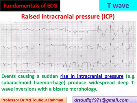 Approach to a patient with T wave abnormality in ECG | PPSX