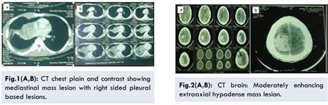 Primary Pulmonary Primitive Neuroectodermal Tumor with CNS Metastasis
