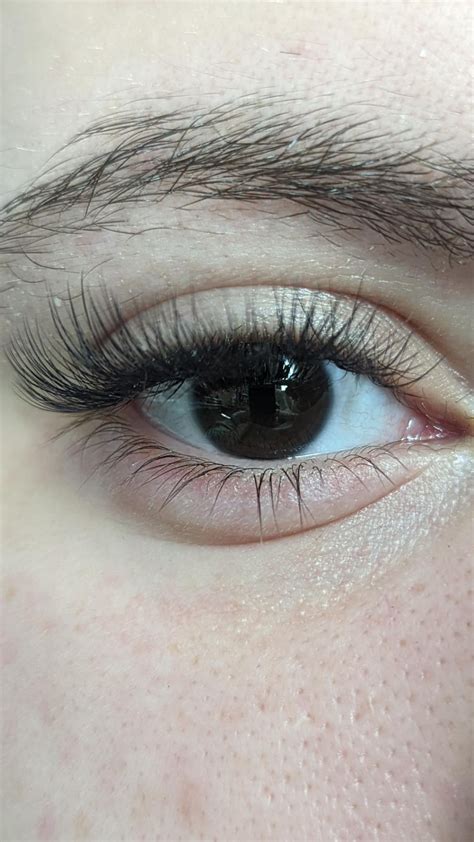 Swollen Lower Eyelid