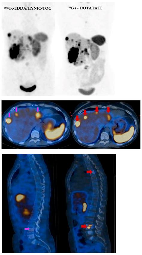 The New Radiolabeled Peptide 99mTcEDDA/HYNIC-TOC: Is It a Feasible Choice for Diagnosing ...