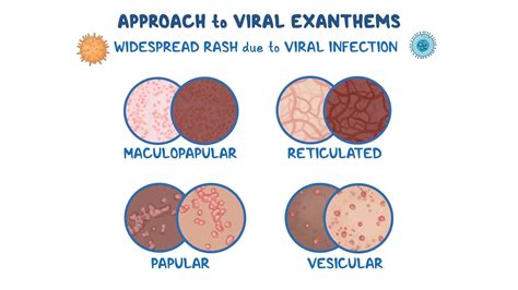 Viral Exanthem Chart National Guidance For The Management Of Children