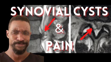 Image result for Explosive Back Cysts