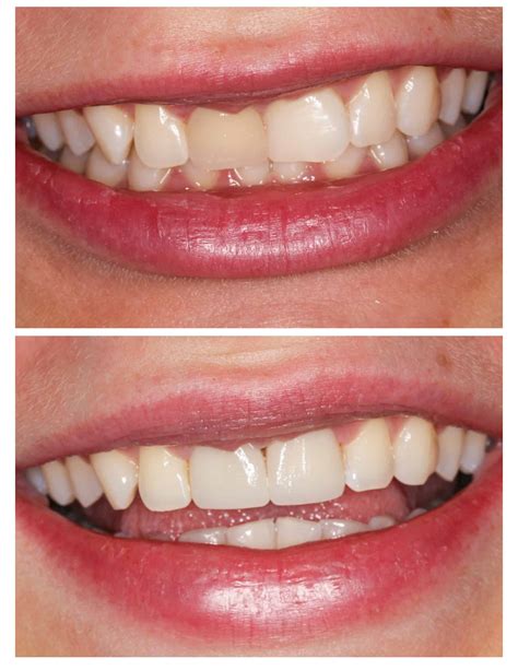 Porcelain Crowns Vs Veneers