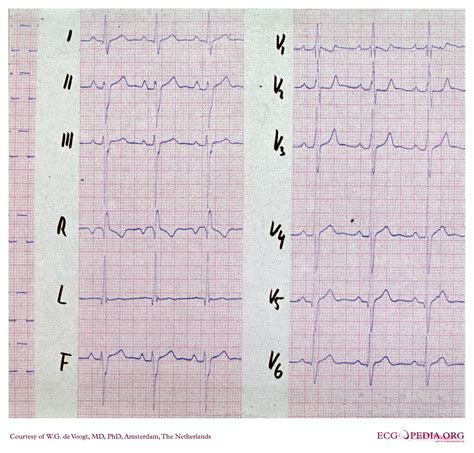 File:DVA2321.jpg - ECGpedia