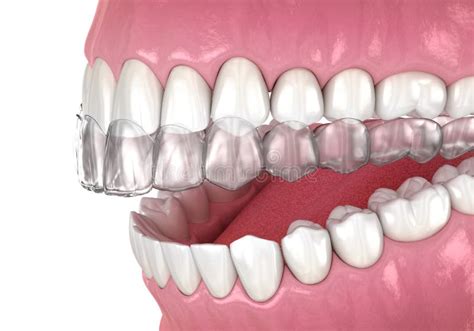 Invisalign Animation 的图像结果