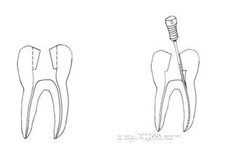 开髓与保护牙体的关系-陈乃焰的博客-KQ88口腔博客