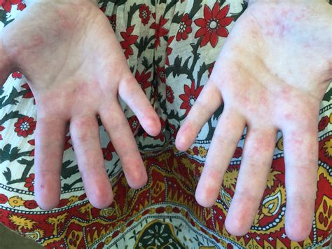 Connective tissue diseases – Queensland Rheumatology Services