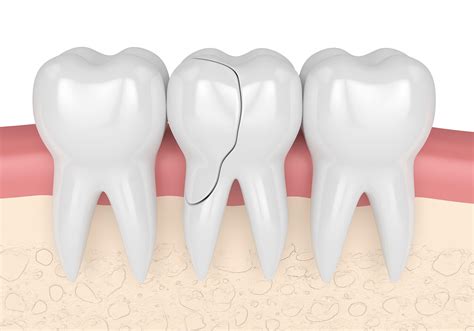 Cracked Molar: Symptoms, Causes & Treatment | Atlas Dental