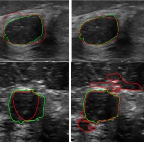 Breast Cancer Malignant Ultrasound Images