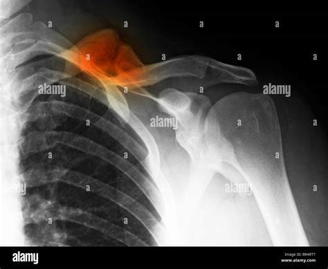 Collarbone x ray hi-res stock photography and images - Alamy