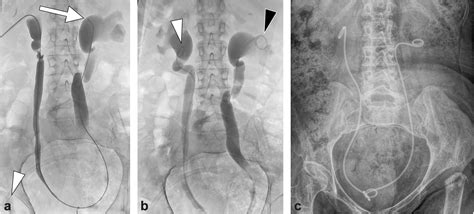 Unilateral Nephrostomy Access for the Placement of Bilateral Ureteral Stents - Journal of ...