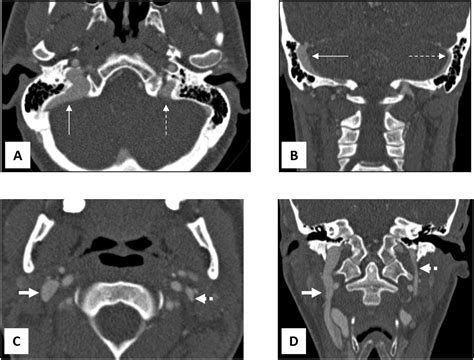 Detecting causes of pulsatile tinnitus on CT arteriography-venography: A pictorial review ...