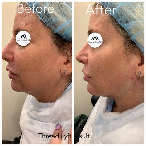 Gallery: Face threads - Anna Avaliani MD - Cosmetic & Laser Surgery Anna Avaliani MD – Cosmetic ...