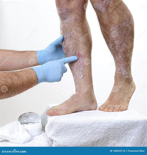 The Dermatologist Visits an Adult Man with Psoriasis in the Legs Stock Photo - Image of foot ...