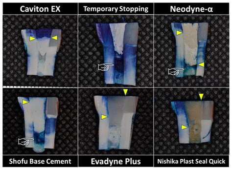 Marginal Leakage of Endodontic Temporary Restorative Materials around ...