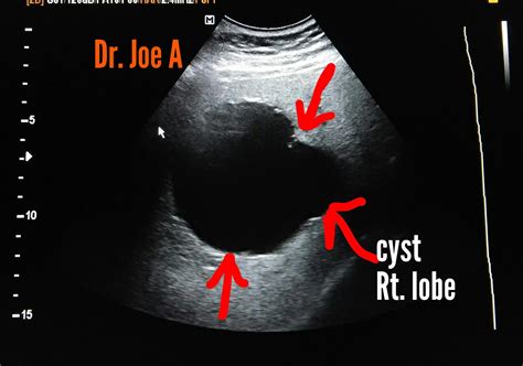 Ultrasound imaging: Simple-hepatic-cyst