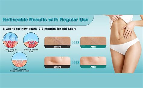 Scar Removal Cream,Scar Gel with Retinol,Advanced Scar Gel,Silicone ...