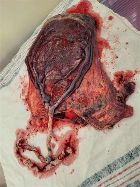 Velamentous Cord Insertion Velamentous Cord Insertion An Important