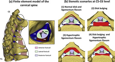 Numerical investigation of the relative effect of disc bulging and ligamentum flavum hypertrophy ...