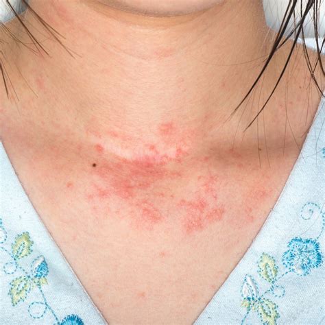 Itchy Rash On Neck Only