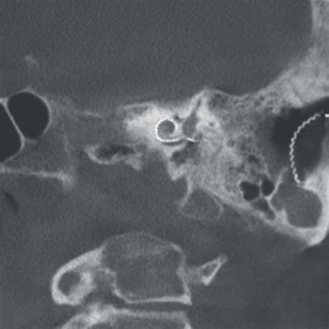 Cochlear implantation and ENT surgery - Ziehm Imaging | EN