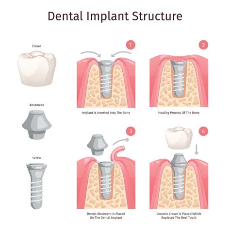 Dental Implants in Manhattan, NYC | SmileWorks
