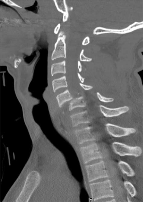 Subaxial Cervical Spine CT | Radiology Key