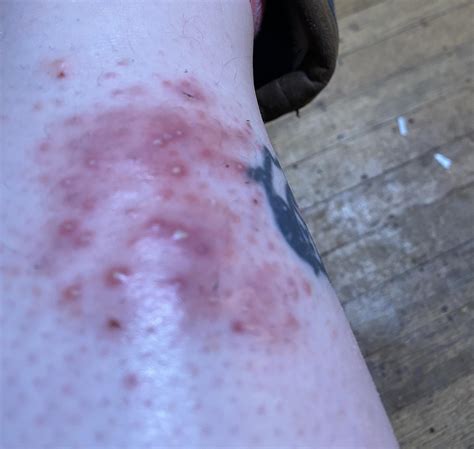 Acv wart removal : DermatologyQuestions