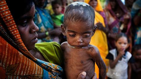 Indore: Rise in serious malnourishment among children; city witnesses ...