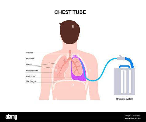 Chest Tube Catheter at Howard Shoults blog