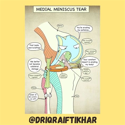 Medial Meniscus Tear: Causes, Symptoms, and Treatment | Dr Iqra Iftikhar posted on the topic ...
