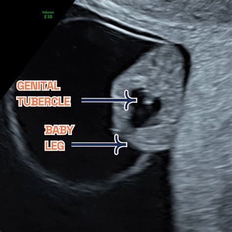 Transvaginal Ultrasound Baby Early Pregnancy Ultrasound Measurements