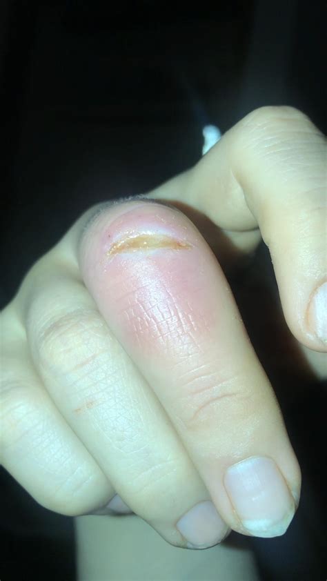 Staph Infection Finger