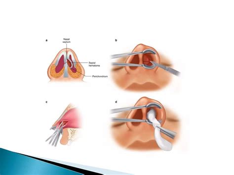 SEPTAL-HAEMATOMA.pptx