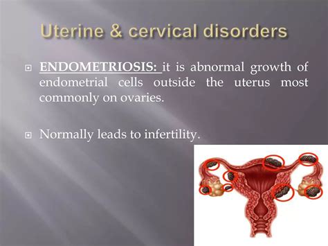Image result for Female Reproductive System Disorders
