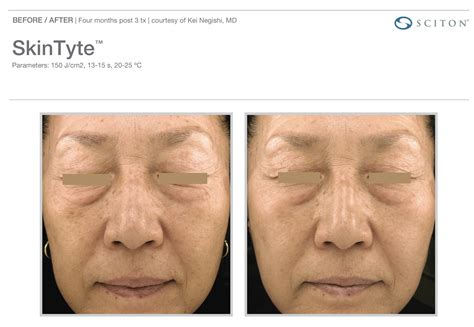 SkinTyte | Skin Tightening Laser Treatment | Bournemouth