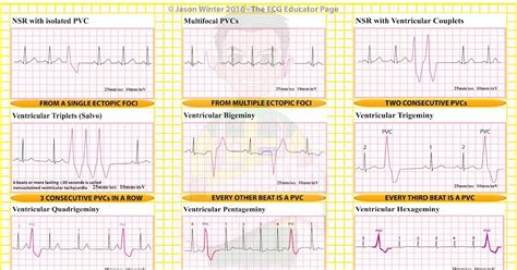 Image result for Pacemaker Programming